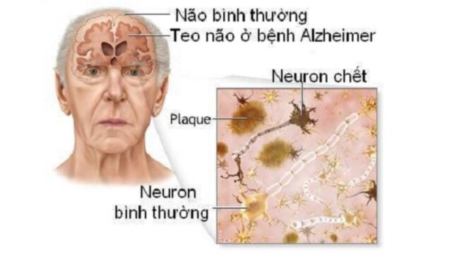 Hầu hết các trường hợp là do bệnh Alzheimer dẫn đến bệnh sa sút trí tuệ ở người già