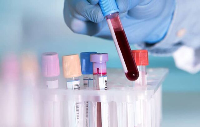 Các xét nghiệm máu khác cũng có thể được thực hiện để tìm ra nguyên nhân bệnh lý