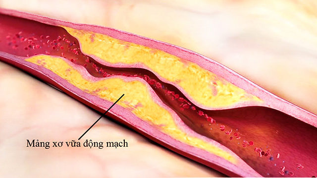 Xơ cứng động mạch – xơ cứng và hẹp các mạch máu cung cấp máu đến ốc tai