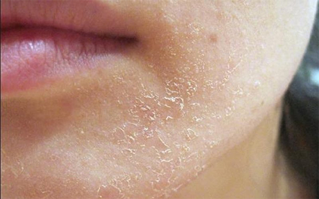 Tình trạng da bị khô thường xuất hiện do thiếu độ ẩm trong cơ thể