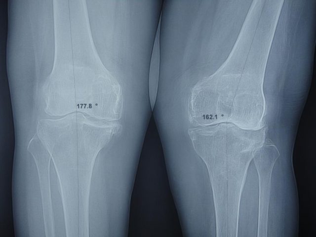 Thoái hóa khớp thường xảy ra đối với xương.